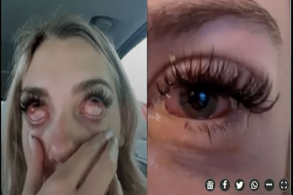 Jovem quase fica cega após fazer extensão de cílios: “Olhos de zumbi”