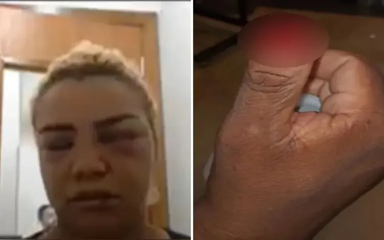 MP pede soltura de mulher que arrancou parte do dedo de policial, em Aparecida